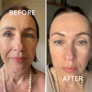 SkinClinic Exosomes Cocktail kursus