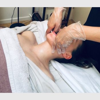 Intra Buccal Face Lifting